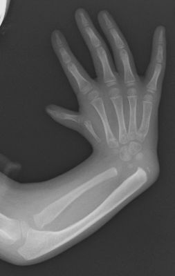 図1b 肘から先の親指側の組織だけがうまく形成されず手首が曲がっている状態のＸ線写真